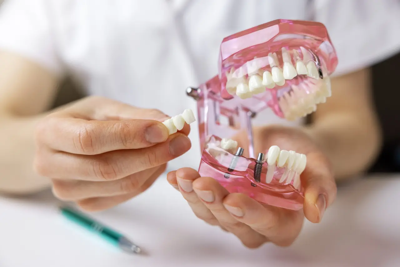 Implant-Supported Bridges