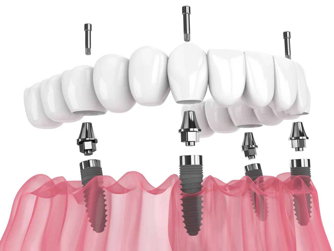 Implant-Supported Dentures / All-on-4