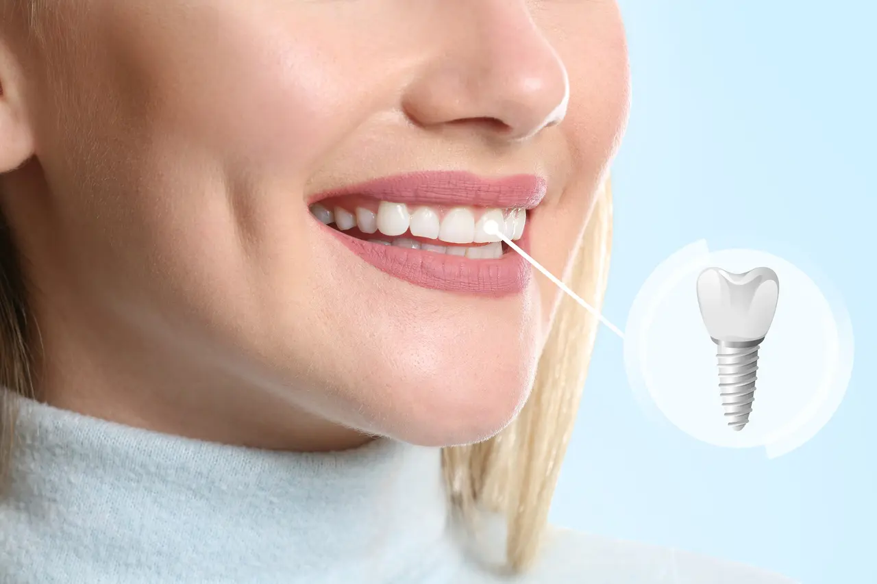 Single-Tooth Dental Implants