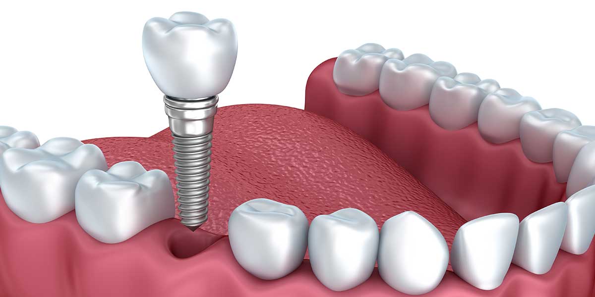 Graphic of Implant